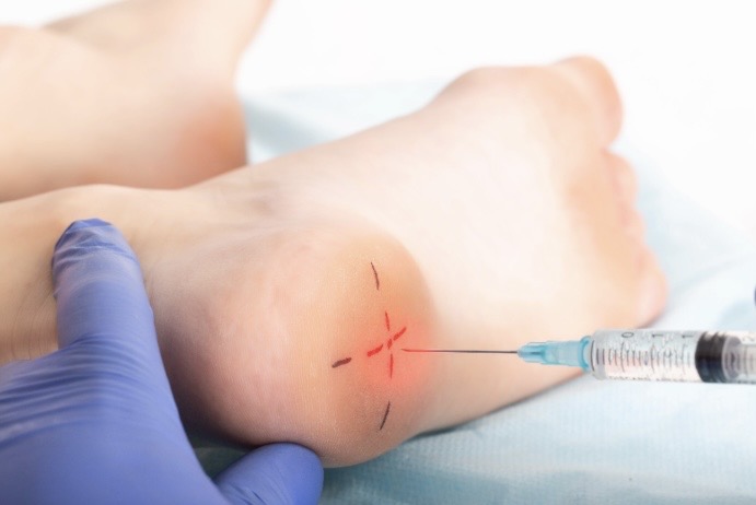 Fascitis plantar, Dr. Ortola, traumatólogo en Calpe