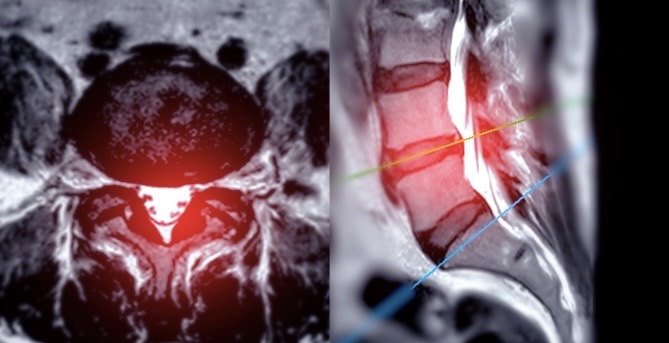Fractura vertebral, Dr. Ortola, traumatólogo en Calpe