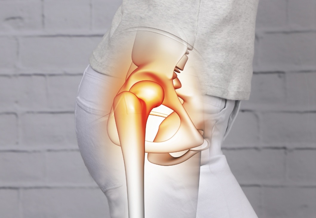 Trocanteritis y bursitis de cadera, Dr. Ortola, traumatólogo en Calpe